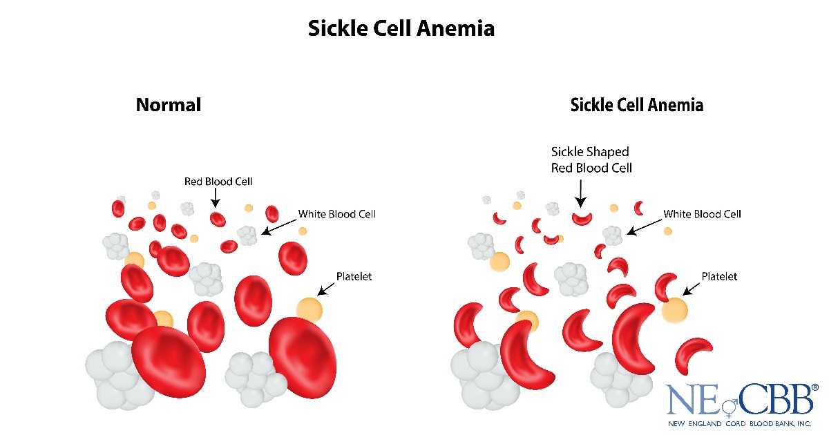 sickle cell treated by cord blood